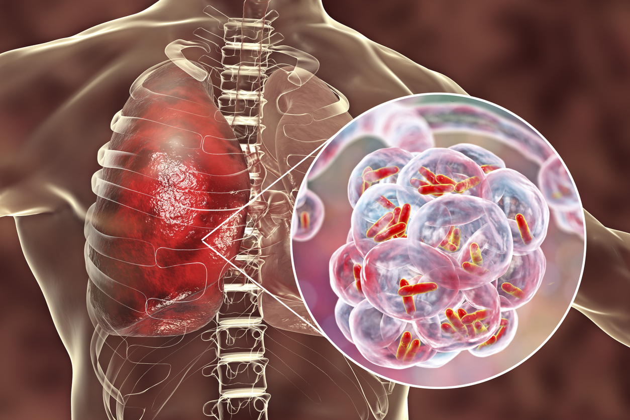 Legionnaires' Disease on the Rise
